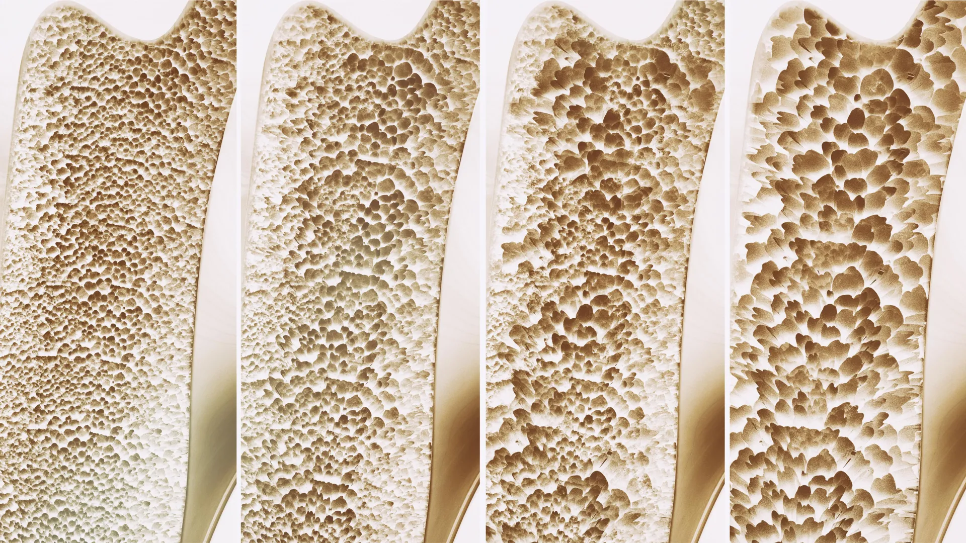 Beyond the Pill: New Study Challenges Decades of Bone Health Guidance