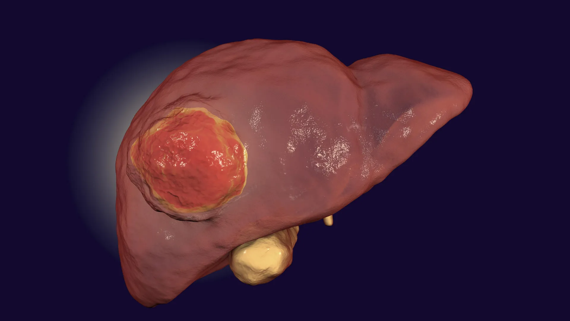 Breaking the Barrier: Researchers Uncover Potential Breakthrough in Treating Aggressive Liver Cancer
