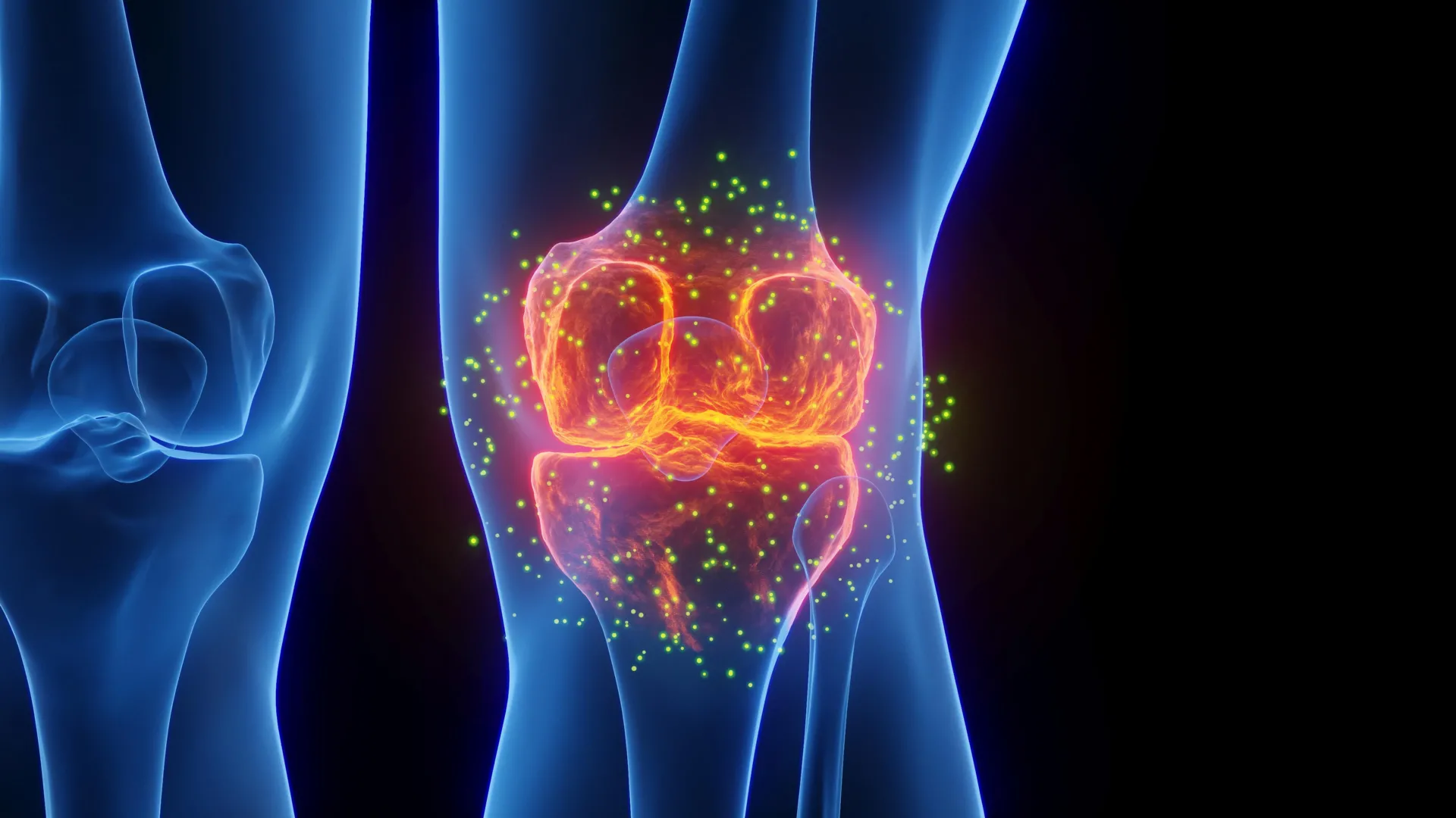 Bridging the Gap: How Genicular Artery Embolization is Redefining Chronic Knee Pain Treatment