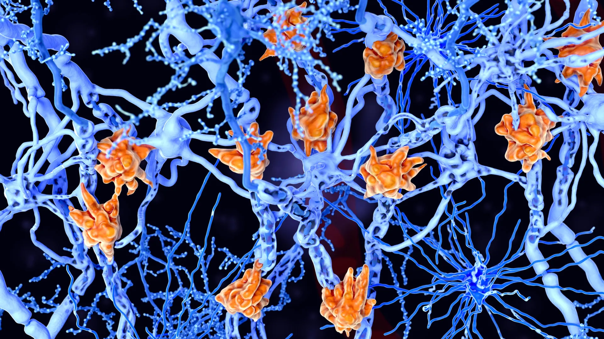 The Hidden Culprit: How ‘Foamy’ Immune Cells Drive Rapid Multiple Sclerosis Progression