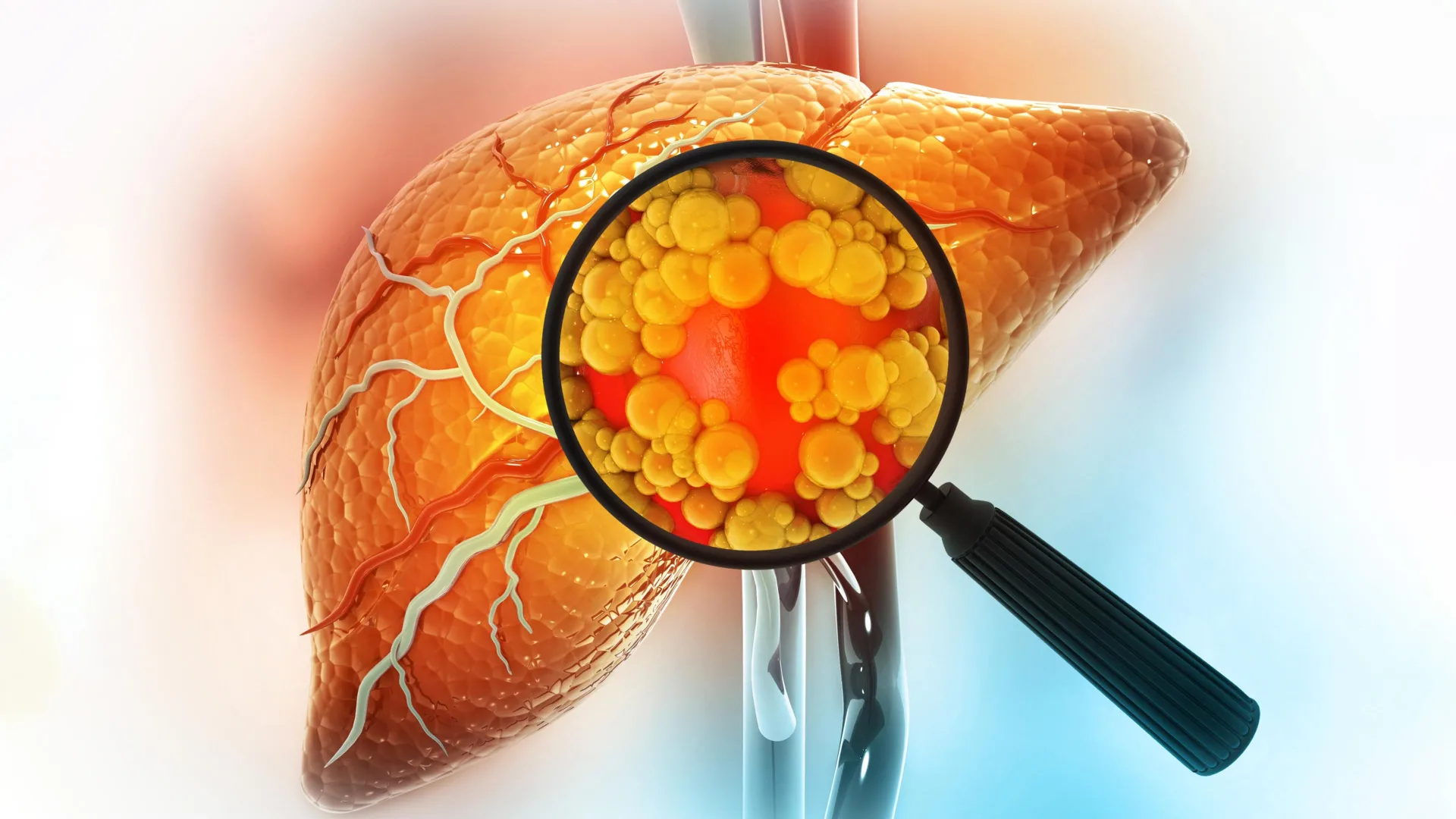 Breaking the Gut-Liver Axis: Breakthrough Experimental Drug Reverses Severe Fatty Liver Disease