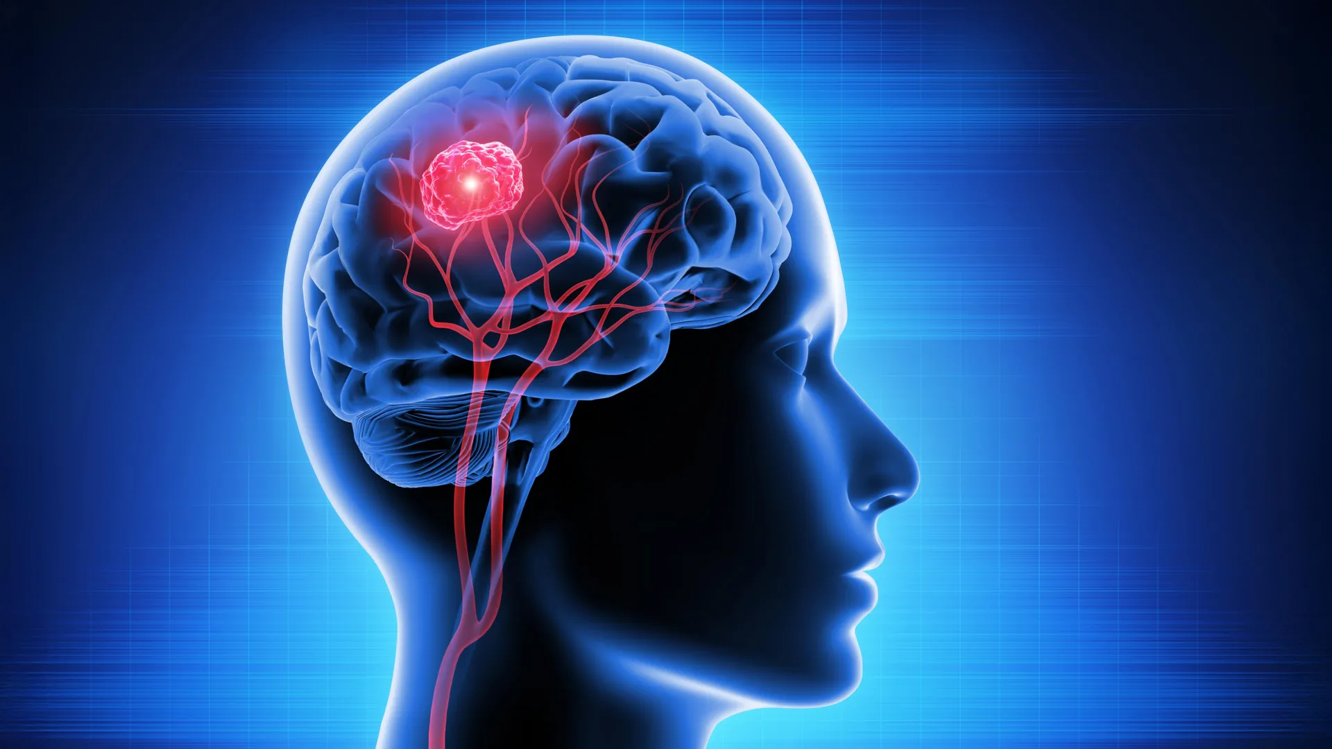 Breakthrough in Neuro-Oncology: Vitamin B12 Derivative Shows Promise Against Glioblastoma