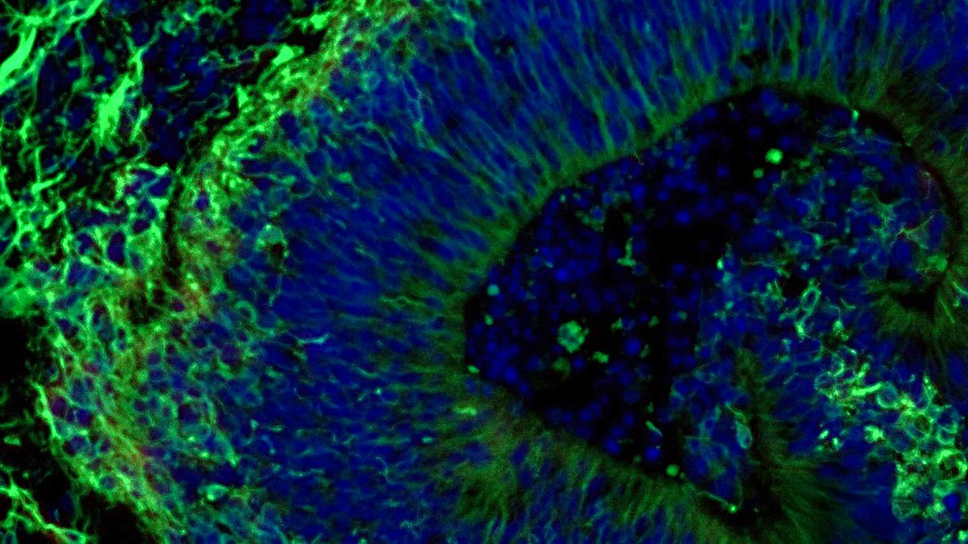 Precision Neurology: How "Mini-Brains" Are Revolutionizing Alzheimer’s Treatment