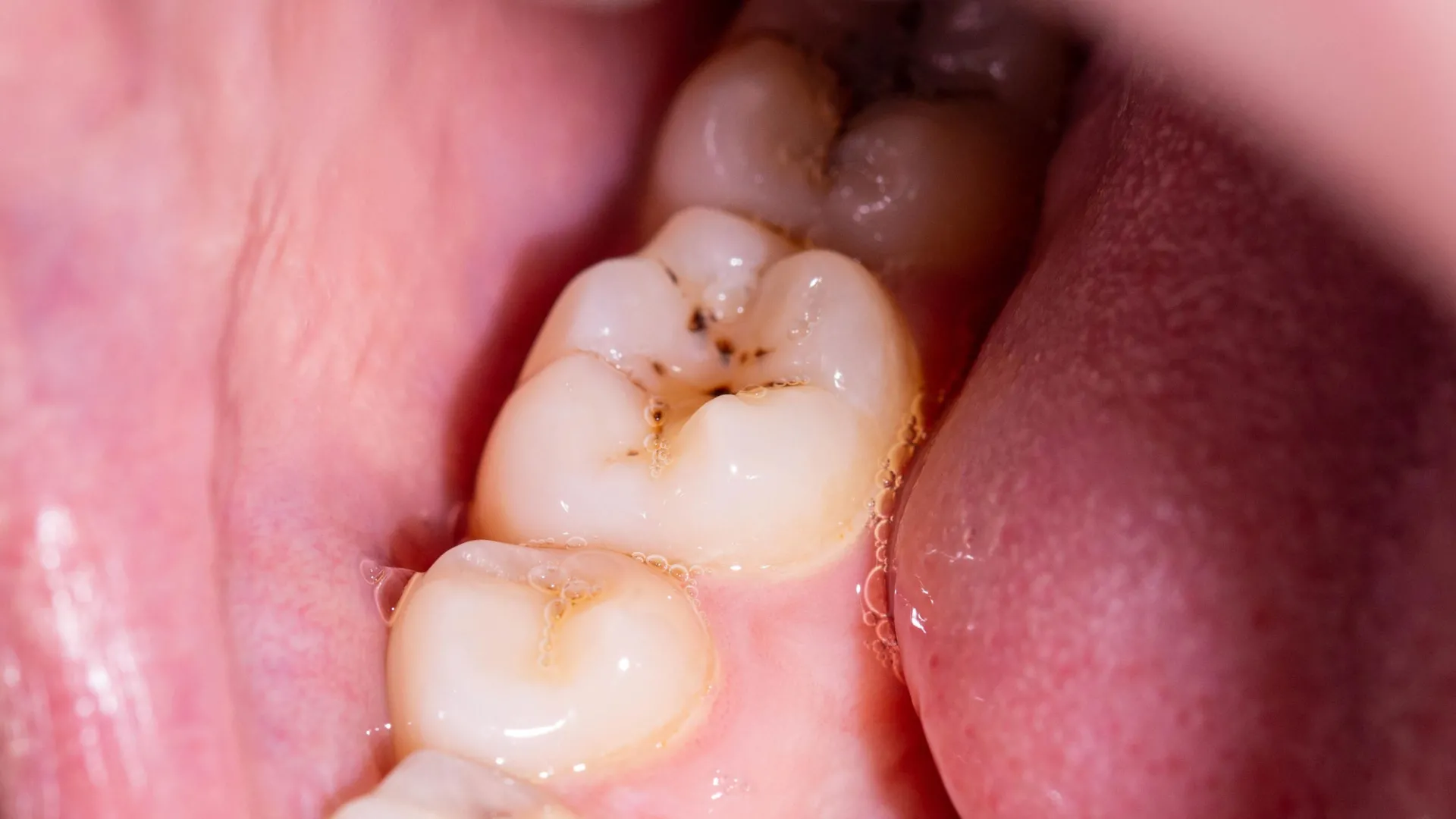 The Future of Dentistry: Scientists Develop Revolutionary Gel to Regrow Human Tooth Enamel