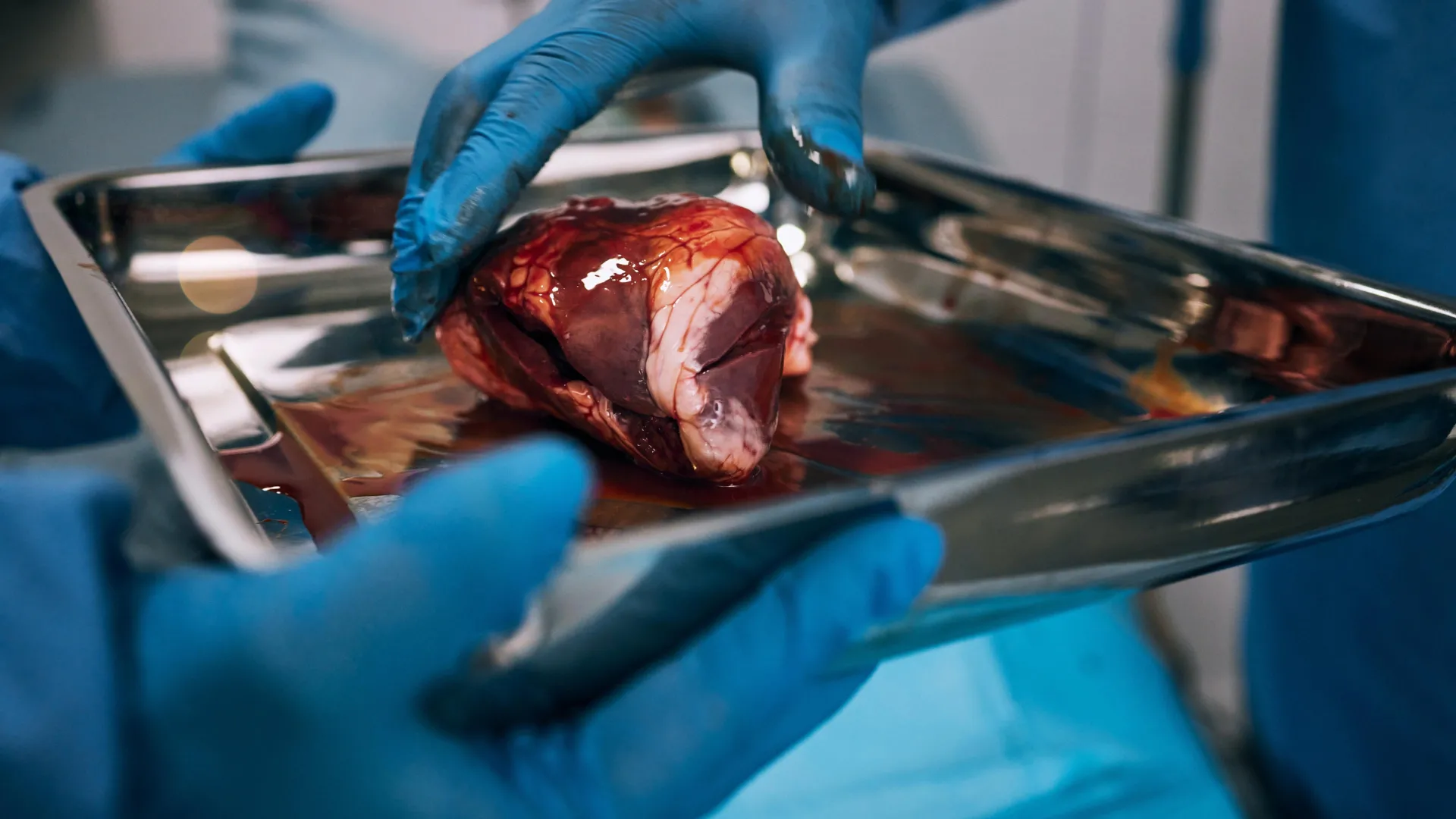 The Invisible Barrier: Why Thousands of Kidney Patients Never Reach the Transplant List