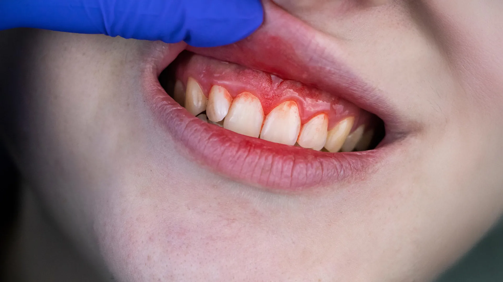 The Silent Connection: Could Your Oral Health Be Compromised by Gum Disease?