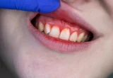 A New Frontier in Periodontal Care: Could Omega-3 and Aspirin Replace Antibiotics?