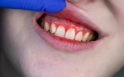 A New Frontier in Periodontal Care: Could Omega-3 and Aspirin Replace Antibiotics?