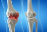 Beyond the Ache: Navigating the Complex Reality of Knee Osteoarthritis