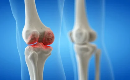 Beyond the Ache: Navigating the Complex Reality of Knee Osteoarthritis