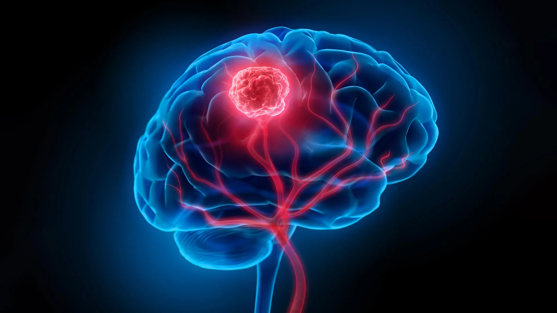 The "Double-Punch" Breakthrough: Engineering a Nano-Solution for Glioblastoma