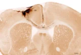Beyond the Permanent: How Neural Stem Cells Are Rewriting the Future of Stroke Recovery