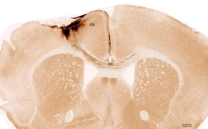 Beyond the Permanent: How Neural Stem Cells Are Rewriting the Future of Stroke Recovery