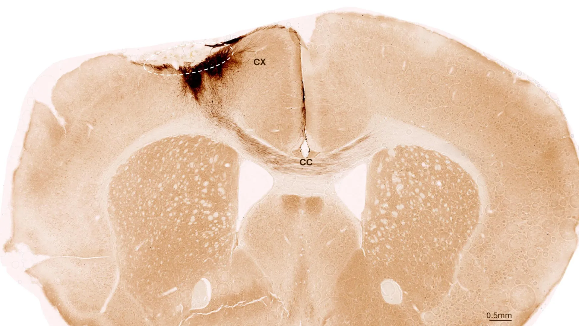 Beyond the Permanent: How Neural Stem Cells Are Rewriting the Future of Stroke Recovery