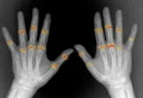 The Blueprint of Pain: How Embryonic Development Dictates the Course of Rheumatoid Arthritis