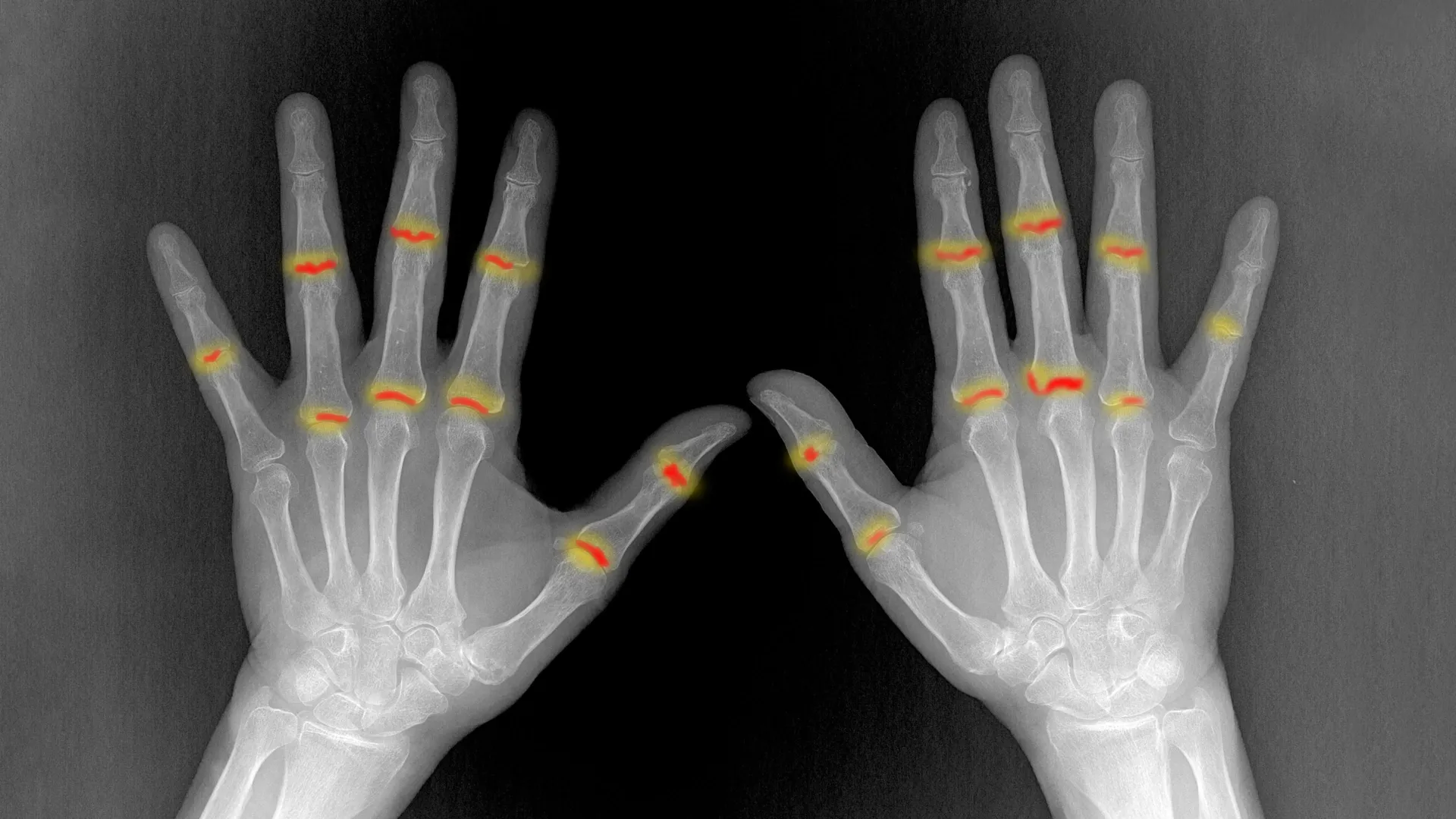 The Blueprint of Pain: How Embryonic Development Dictates the Course of Rheumatoid Arthritis