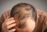 The Genetic Connection: New Study Links GLP-1 Medications to Increased Hair Loss Risk in Men