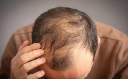 The Genetic Connection: New Study Links GLP-1 Medications to Increased Hair Loss Risk in Men