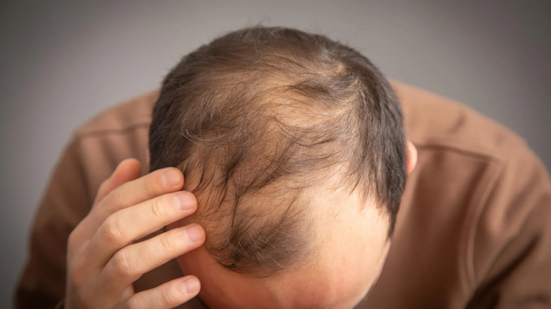 The Genetic Connection: New Study Links GLP-1 Medications to Increased Hair Loss Risk in Men