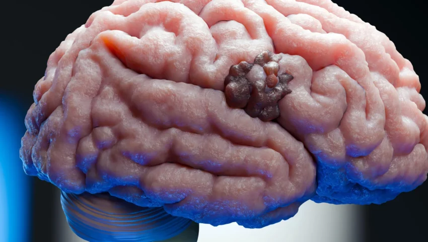 Unlocking a Biological Achilles’ Heel: New Research Targets Glioblastoma Resilience