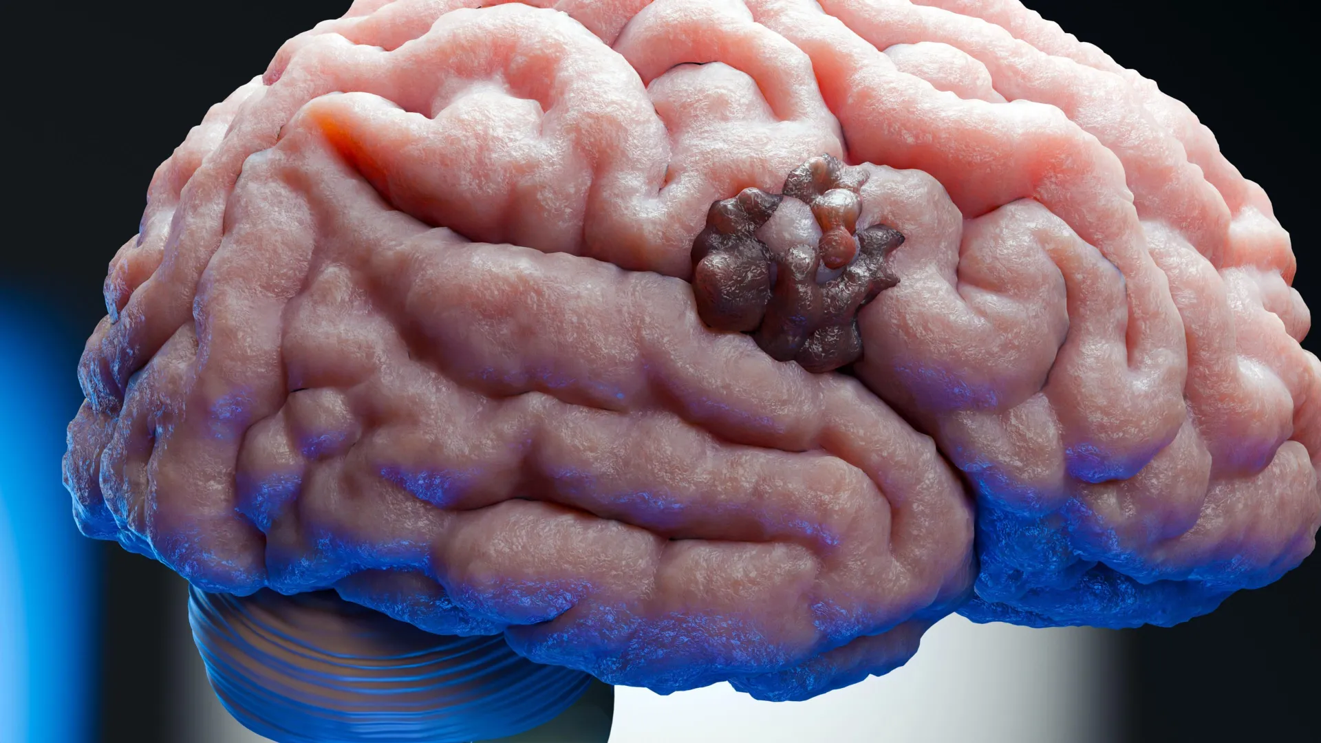 Unlocking a Biological Achilles’ Heel: New Research Targets Glioblastoma Resilience