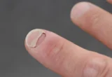 Beyond the Waistline: New Research Links Popular GLP-1 Medications to Unexpected Nail and Scalp Conditions