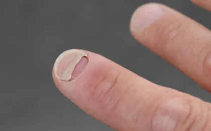 Beyond the Waistline: New Research Links Popular GLP-1 Medications to Unexpected Nail and Scalp Conditions