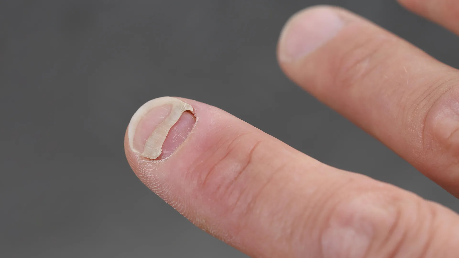 Beyond the Waistline: New Research Links Popular GLP-1 Medications to Unexpected Nail and Scalp Conditions