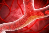 Silent Threat: Landmark Study Reveals Atherosclerosis Begins Earlier Than Previously Believed