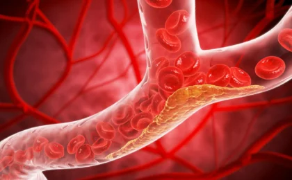 Silent Threat: Landmark Study Reveals Atherosclerosis Begins Earlier Than Previously Believed