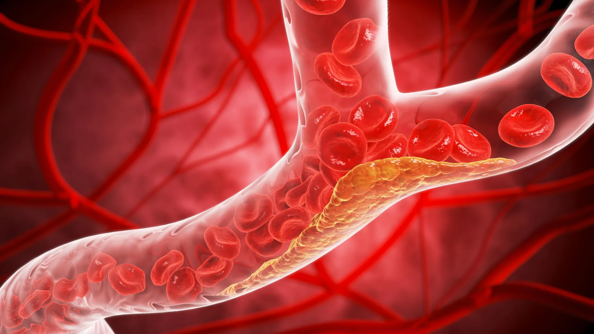 Silent Threat: Landmark Study Reveals Atherosclerosis Begins Earlier Than Previously Believed