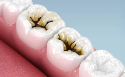 The End of the Drill? How a Simple Liquid is Revolutionizing Pediatric Dentistry