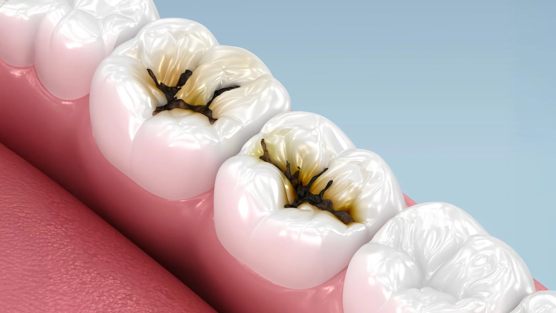 The End of the Drill? How a Simple Liquid is Revolutionizing Pediatric Dentistry