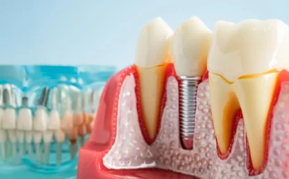 The Hidden Saboteur: Unlocking the Mystery of Dental Implant Failure