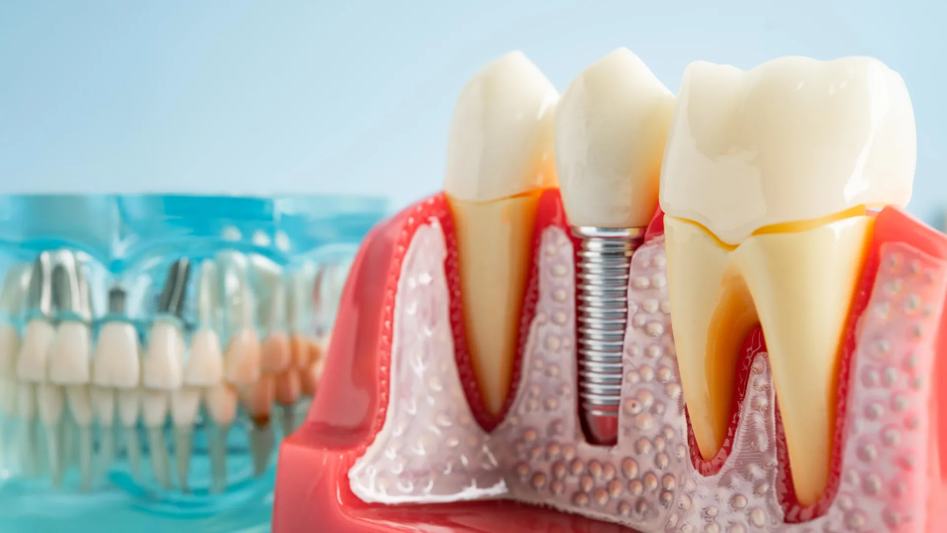 The Hidden Saboteur: Unlocking the Mystery of Dental Implant Failure