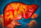The Hidden Toll: How Ubiquitous Polyethylene Microplastics May Be Fueling a Global Liver Crisis