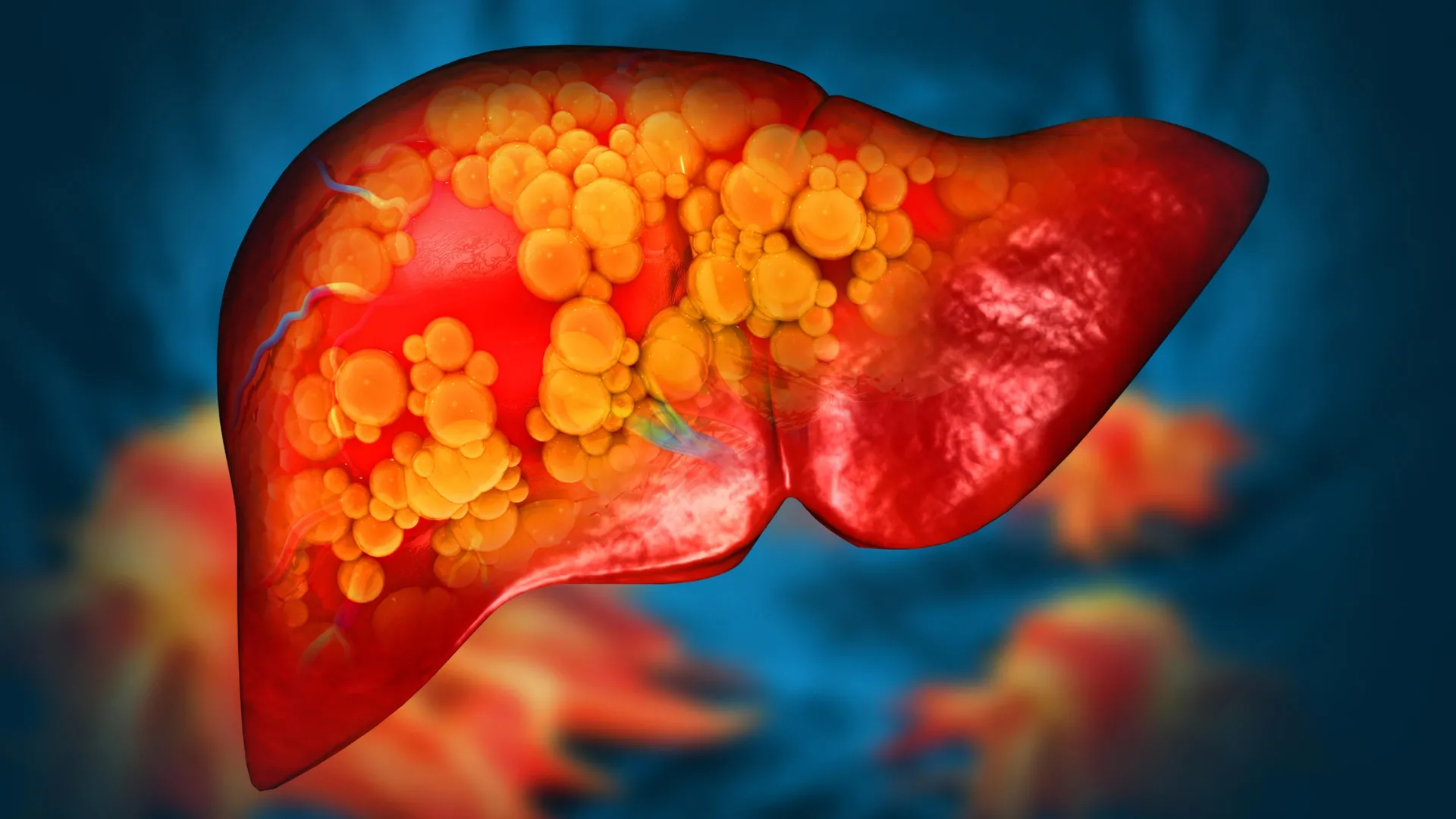 The Hidden Toll: How Ubiquitous Polyethylene Microplastics May Be Fueling a Global Liver Crisis