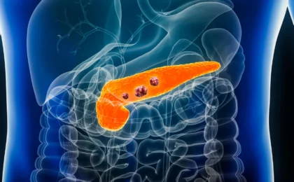 The Silent Sentinel: How AI Breakthrough REDMOD is Rewriting the Future of Pancreatic Cancer Detection