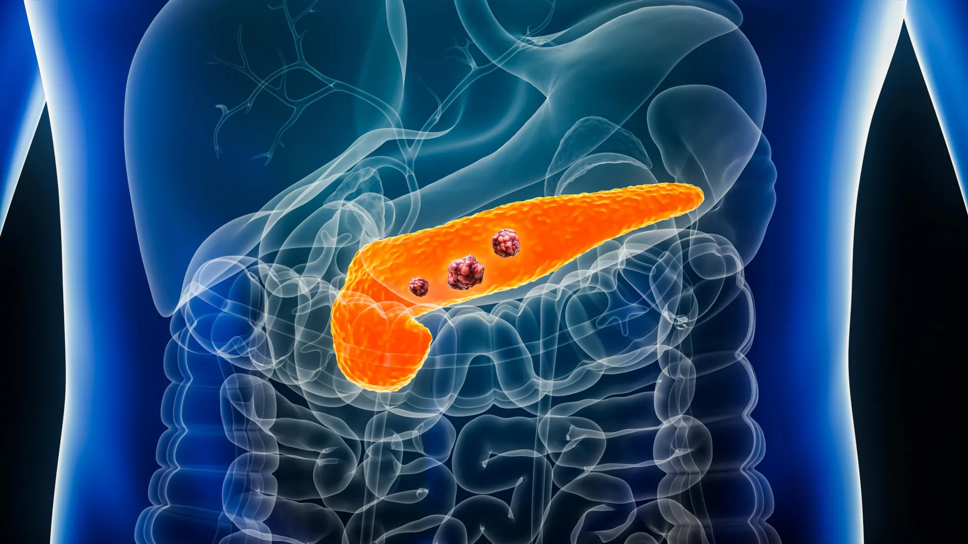 The Silent Sentinel: How AI Breakthrough REDMOD is Rewriting the Future of Pancreatic Cancer Detection